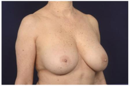 After image 2 Case #102336 - Breast Augmentation Revision