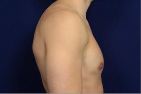 After image 3 Case #102751 - Gynecomastia