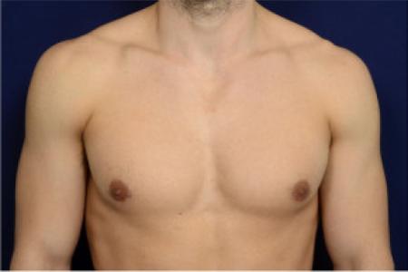 After image 1 Case #102751 - Gynecomastia