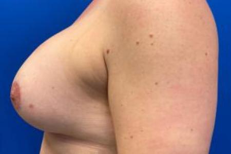 After image 3 Case #103276 - Silicone Breast Augmentation for a 38 year old female