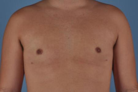 After image 1 Case #103221 - Male Breast Reduction