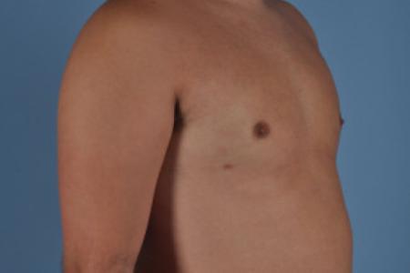 After image 2 Case #103221 - Male Breast Reduction