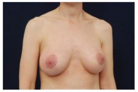 After image 2 Case #103001 - Augmentation Mastopexy