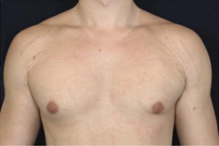 After image 1 Case #102376 - Gynecomastia