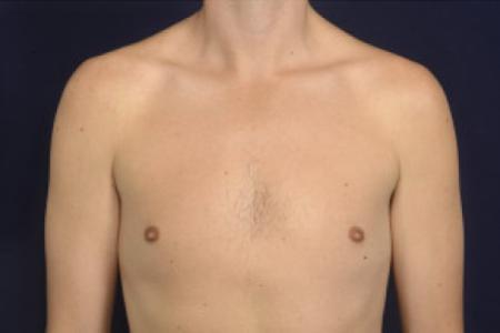 After image 1 Case #102491 - Gynecomastia