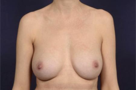 After image 1 Case #103031 - Breast Augmentation Revision