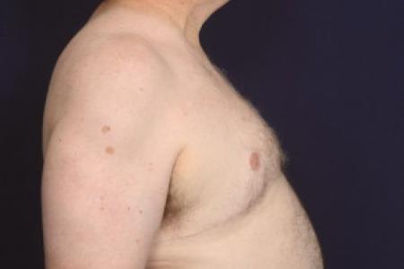 After image 3 Case #102581 - Gynecomastia