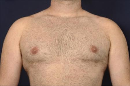 After image 1 Case #102481 - Gynecomastia