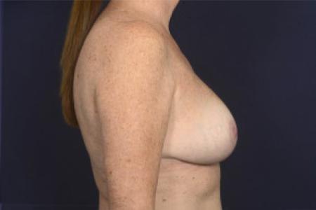After image 3 Case #102391 - Breast Reduction