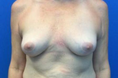 After image 1 Case #103336 - Removal of Implants with Fat Grafting to Breasts for a 50 year old female