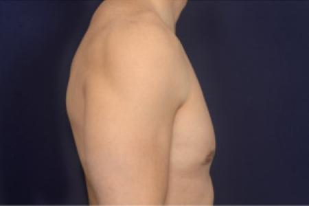 After image 3 Case #102411 - Gynecomastia
