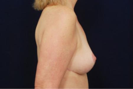 After image 3 Case #102996 - Mastopexy