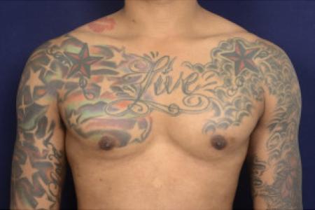After image 1 Case #102466 - Gynecomastia