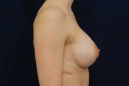After image 3 Case #102691 - Breast Augmentation