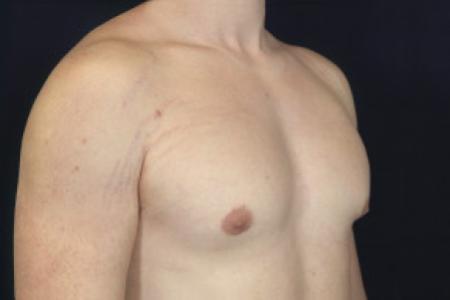 After image 2 Case #102376 - Gynecomastia
