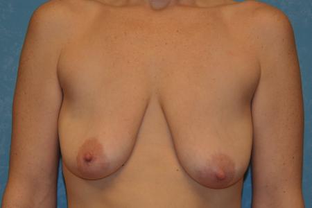 Before image 1 Case #103626 - Breast Lift with Implants