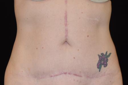 After image 1 Case #105241 - Mini Abdominoplasty with Liposuction