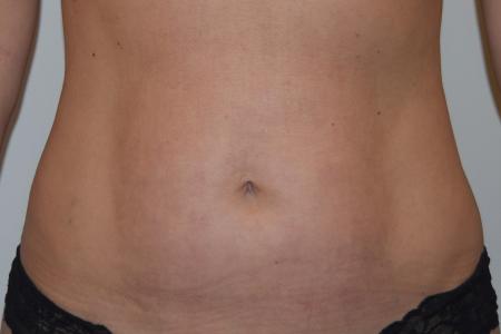 After image 1 Case #105271 - Liposuction, Cellfina, BodyTite & Morpheus8