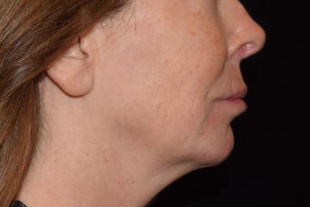 After image 3 Case #105226 - Filler Before & After with Dr. David P. Rapaport