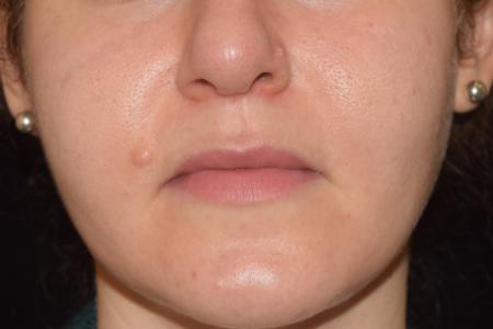 Before image 1 Case #105336 - Mole Removal