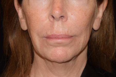Before image 1 Case #105226 - Filler Before & After with Dr. David P. Rapaport