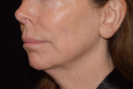 Before image 2 Case #105226 - Filler Before & After with Dr. David P. Rapaport