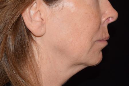 Before image 3 Case #105226 - Filler Before & After with Dr. David P. Rapaport