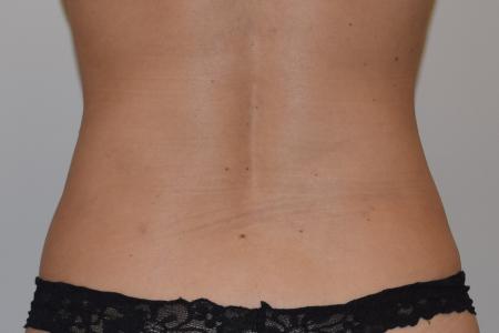 After image 3 Case #105271 - Liposuction, Cellfina, BodyTite & Morpheus8