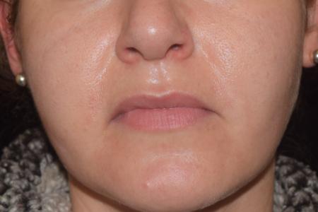 After image 1 Case #105336 - Mole Removal