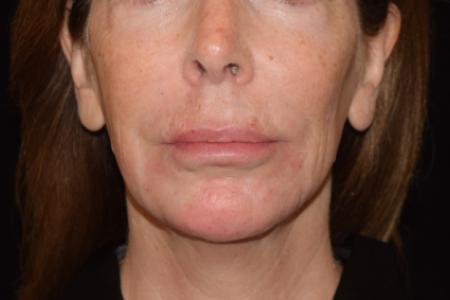 After image 1 Case #105226 - Filler Before & After with Dr. David P. Rapaport