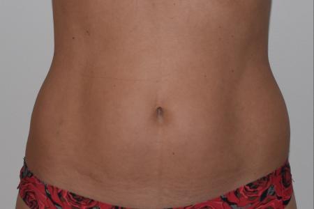 Before image 1 Case #105271 - Liposuction, Cellfina, BodyTite & Morpheus8