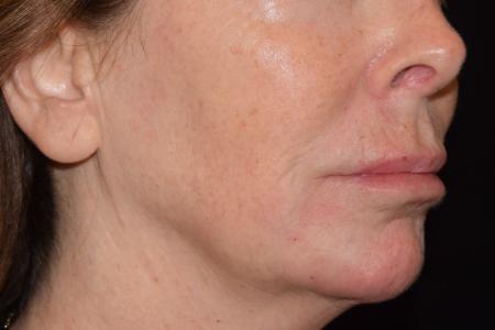 After image 4 Case #105226 - Filler Before & After with Dr. David P. Rapaport