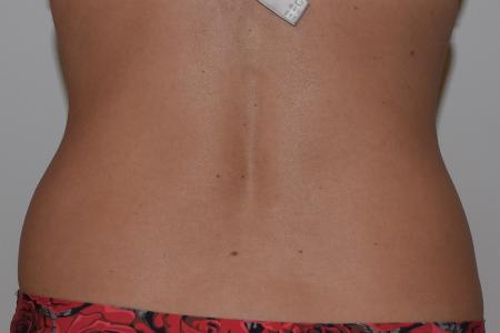 Before image 3 Case #105271 - Liposuction, Cellfina, BodyTite & Morpheus8