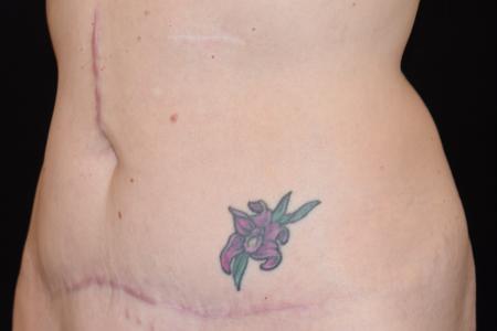 After image 2 Case #105241 - Mini Abdominoplasty with Liposuction