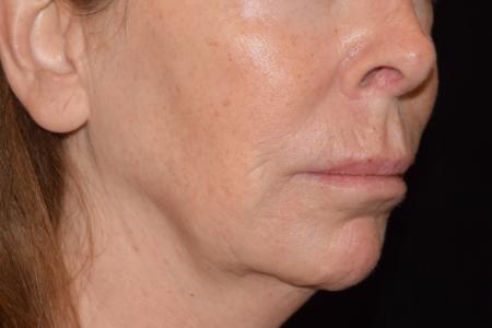 Before image 4 Case #105226 - Filler Before & After with Dr. David P. Rapaport