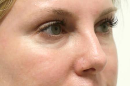 Before image 2 Case #105521 - Female Eyelid Lift