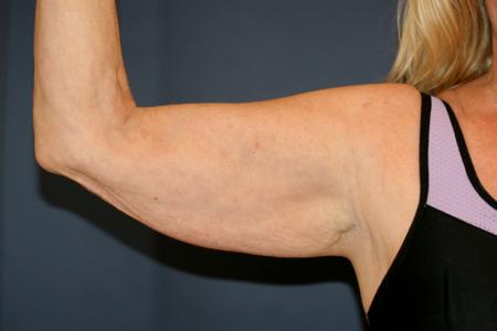 Before image 1 Case #105411 - Upper Arm Lift