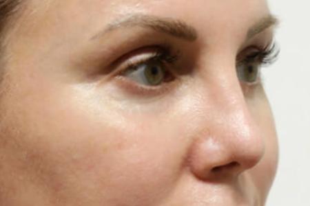 After image 2 Case #105521 - Female Eyelid Lift