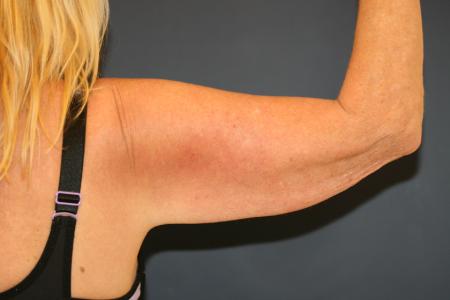 Before image 2 Case #105411 - Upper Arm Lift