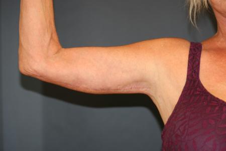 After image 1 Case #105411 - Upper Arm Lift