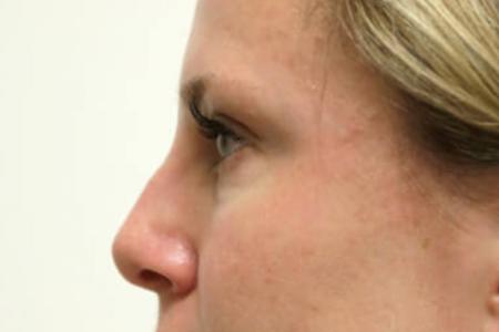 Before image 3 Case #105521 - Female Eyelid Lift