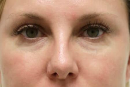 Before image 1 Case #105521 - Female Eyelid Lift