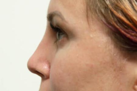 After image 3 Case #105521 - Female Eyelid Lift