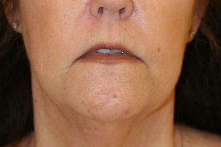 Before image 1 Case #105486 - Corner Lip Lift