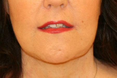 After image 1 Case #105486 - Corner Lip Lift