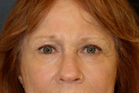 After image 1 Case #106231 - Female Brow Lift