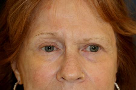 Before image 1 Case #106231 - Female Brow Lift