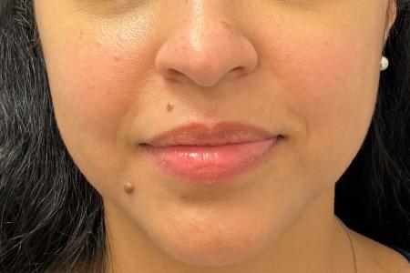 Before image 1 Case #107936 - Cosmetic Mole Removal (Nose, Upper Lip & Chin)