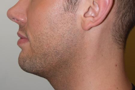 After image 2 Case #107881 - Male Facial Contouring with Morpheus8