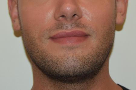 Before image 1 Case #107881 - Male Facial Contouring with Morpheus8
